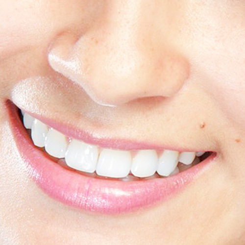 Veneers Lächeln Pixabay